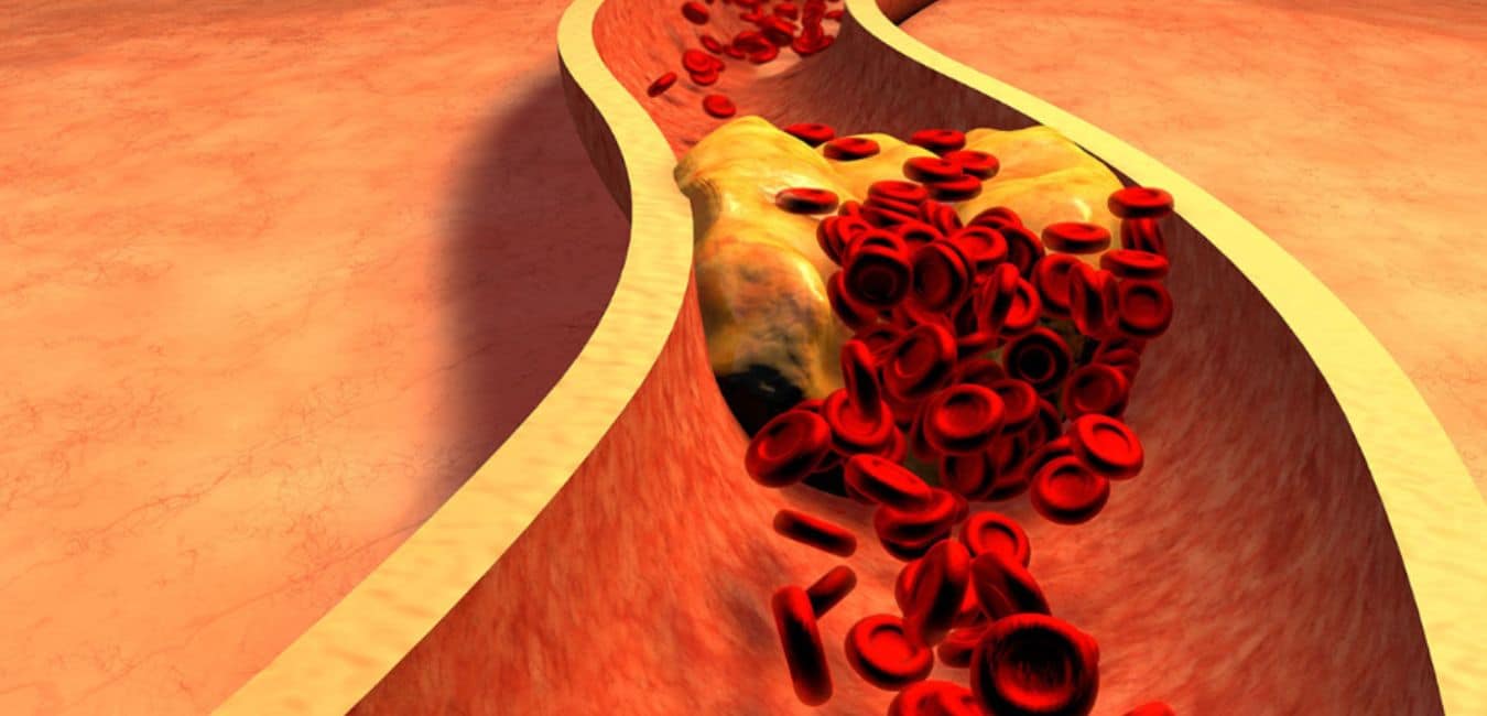 The Best Understanding of Peripheral Arterial Disease with KCVI
