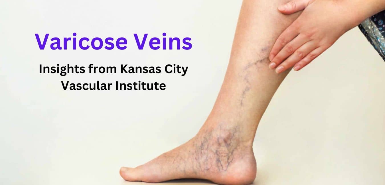 Varicose veins on a person's leg
